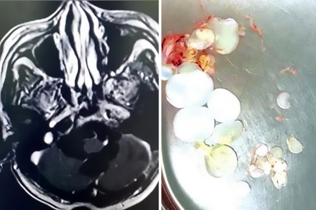 30 trứng sán dây làm tổ trong đầu bệnh nhân ở Trung Quốc.