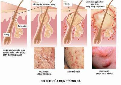 trị mụn