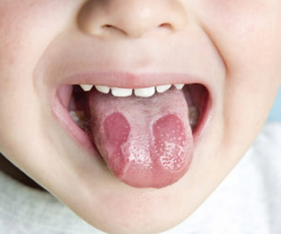 '. Điểm mặt 6 dấu hiệu bất thường ở vùng lưỡi cảnh báo vấn đề nguy hiểm về sức khỏe không thể bỏ qua .'
