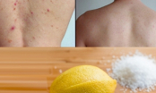 Trị dứt điểm mụn ở lưng chỉ với những nguyên liệu có sẵn tại nhà