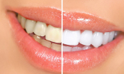Chỉ sau 5 phút nhờ thứ này bạn đã lấy sạch cao răng để đón tết