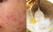 Mẹo siêu đơn giản giúp trị mụn trứng cá dứt điểm không để lại thâm sẹo