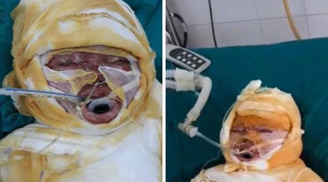 Ngã vào nồi bỗng rượu nóng, bé gái 26 tháng tuổi bị bỏng nặng Ngã vào nồi bỗng rượu nóng, bé gái 26 tháng tuổi bị bỏng nặng