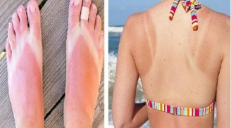 14 bí kíp làm giảm đau rát khi da bị cháy nắng 14 bí kíp làm giảm đau rát khi da bị cháy nắng