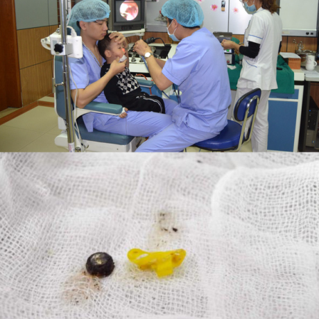 Cấp cứu bé trai 32 tháng tuổi, bác sĩ tá hỏa khi phát hiện ra vật này trong mũi bé