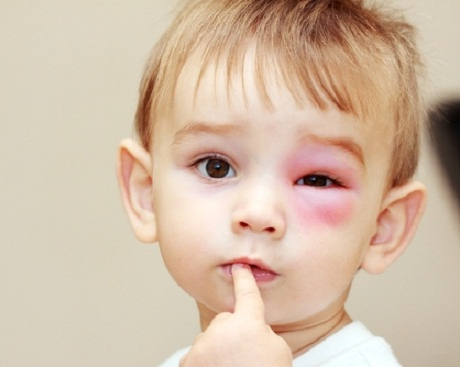 4 cách làm dịu vết ong đốt đơn giản nhất