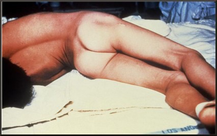 Một bệnh nhân uốn ván bị cong lưng và co thắt cơ bắp