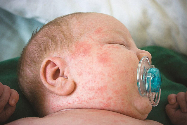 Không tiêm phòng vắc xin bệnh sởi bé có nguy cơ biến chứng nguy kịch