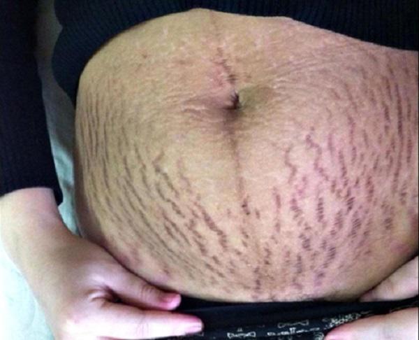 Vết rạn da của một bà mẹ mới sinh con sau 3 tháng tuổi