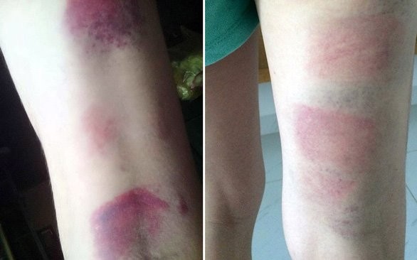 Chân của 2 em học sinh sau khi bị cô giáo đánh.