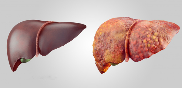 Lá gan khoẻ mạnh (trái) và lá gan bị xơ với nhiều u cục
