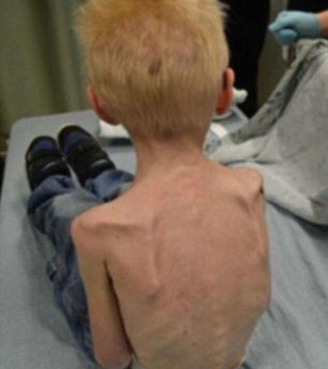 Cậu bé Jordan tại thời điểm được cảnh sát tìm thấy và giải cứu, chỉ còn da bọc xương.