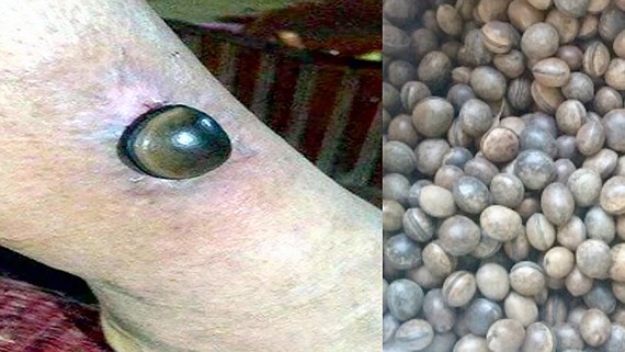 Sử dụng hạt đậu Lào để làm thuốc chữa bệnh thực chất là mẹo chữa bệnh truyền miệng