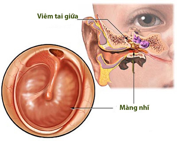 viem-tai-giua