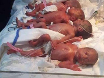 Mang thai 5 nhưng sản phụ lại sinh ra 6 đứa trẻ khiến ai cũng bất ngờ