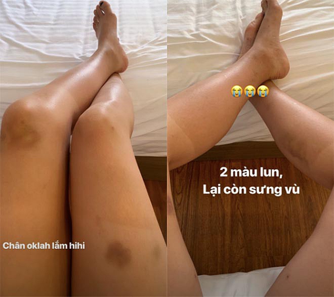 Hình ảnh đôi chân bầm tím của Kỳ Duyên.    
