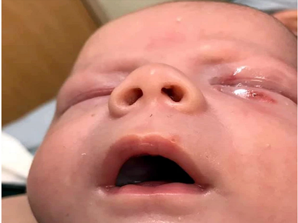 Em bé 4 tuần tuổi bị nhiễm bệnh do nụ hôn của người lớn
