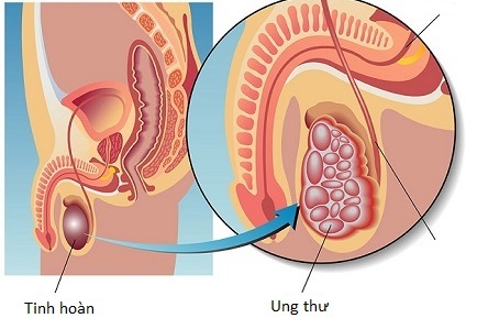 3 benh ung thu co the chua khoi o dan ong-phunutoday6