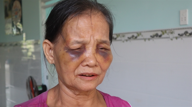 Người phụ nữ bị con dâu đánh bầm tím mặt.