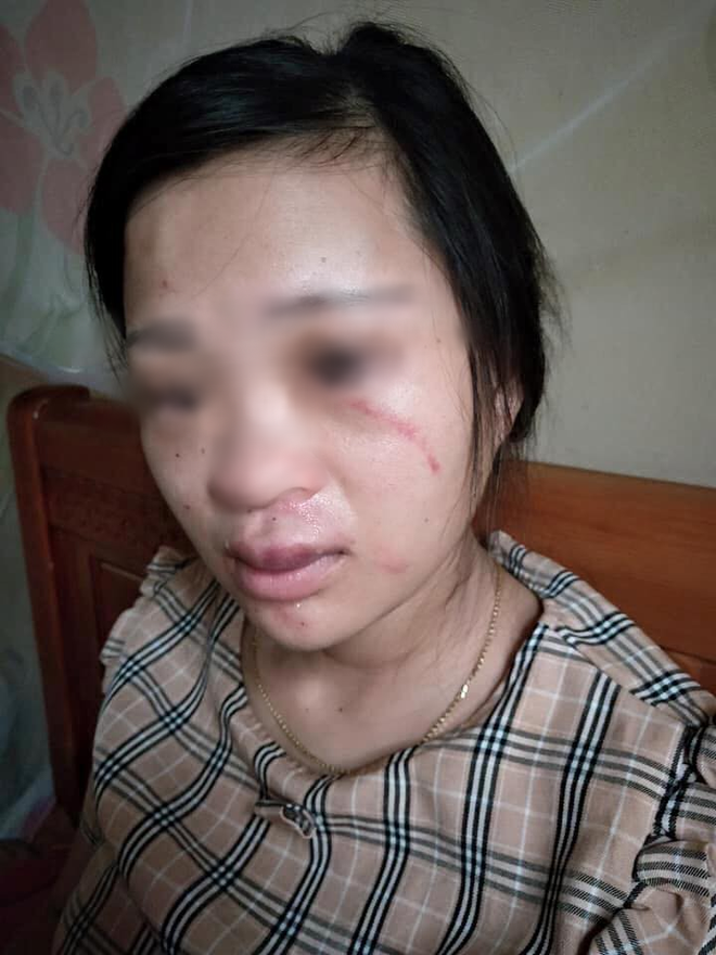 Thai phụ bị chồng đánh không thương tiếc.