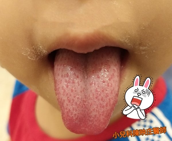 Sốt cao đi kèm với việc lưỡi xuất hiện chấm đỏ là dấu hiệu cảnh báo có thể trẻ đang bị một căn bệnh nguy hiểm.