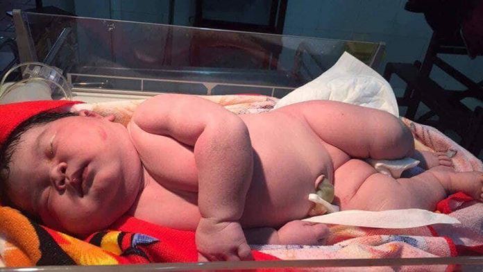 Em bé sinh ra đã có cân nặng của một đứa trẻ 4-5 tháng tuổi.