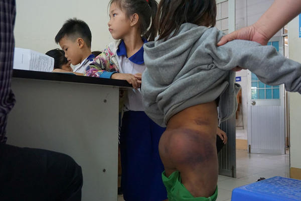 Hình ảnh một học sinh bị bạo hành bầm tím cơ thể. Ảnh: báo Thanh Niên
