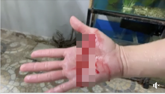 Vết thương ở tay củ Đan Trường có vẻ khá sâu khiến tay anh chảy máu khá nhiều.