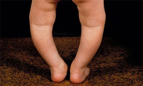 Trẻ đi giày không đúng cỡ chân dễ bị ảnh hưởng dáng đi