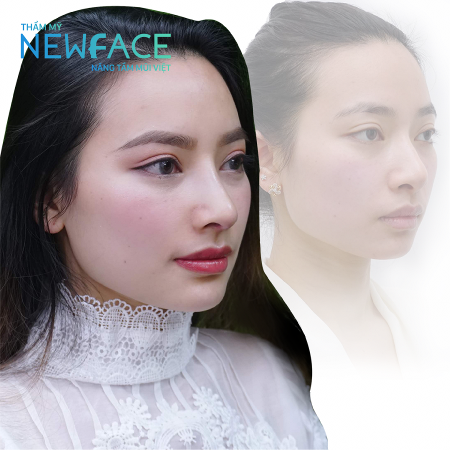 Tuyết Linh – Việt kiều Mỹ trước và sau nâng mũi sụn sườn và độn cằm cùng Thẩm mỹ viện NEWFACE