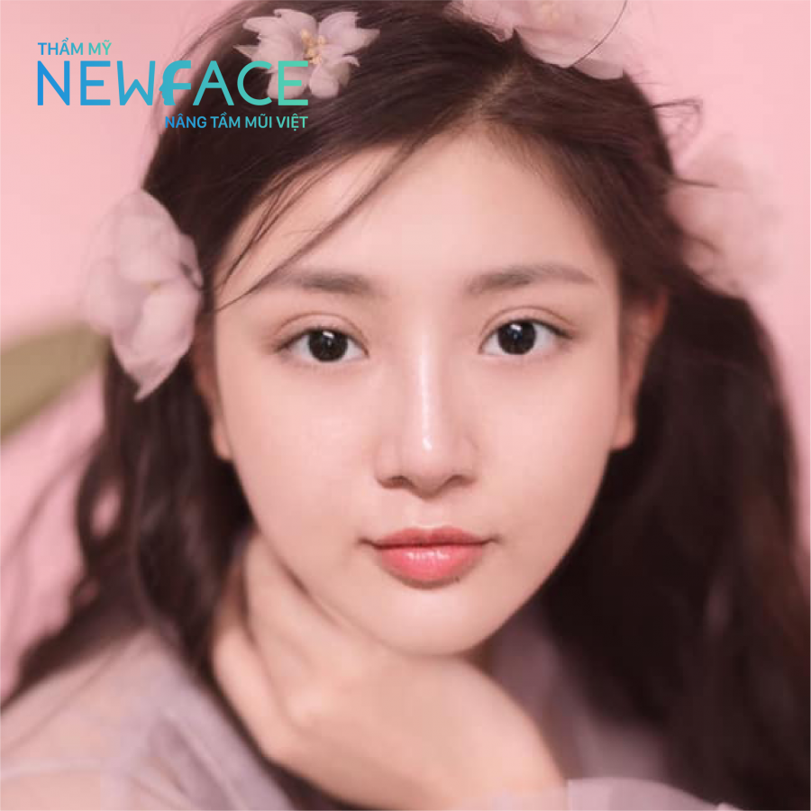 Khách hàng Kim Trân xinh đẹp sau nâng mũi cấu trúc cùng Thẩm mỹ viện NEWFACE