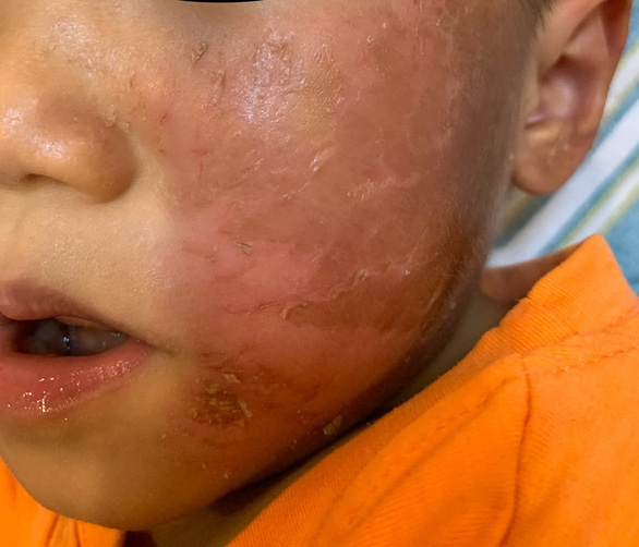 Bé trai bị bỏng rộp da sau khi đeo mặt nạ siêu nhân Halloween.