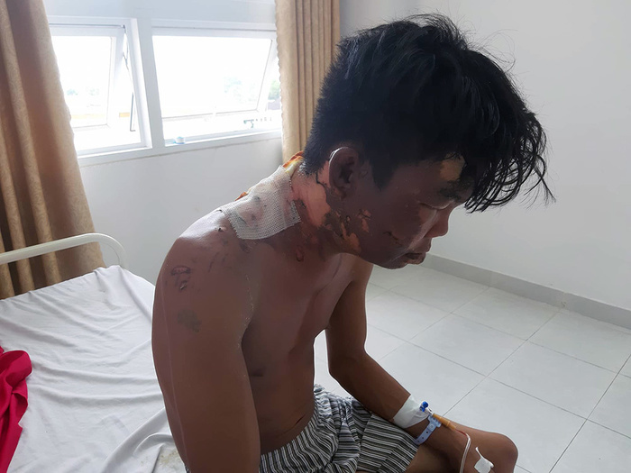Thanh niên tố bị chị đổ nước sôi lên người gây bỏng nặng. Ảnh: báo VietNamNet