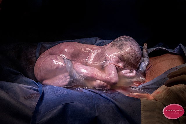 Một em bé sinh ra vẫn còn nguyên bọc ối. Đây là một ca sinh hiếm gặp, chiếm tỉ lệ 1/80.000 ca sinh.