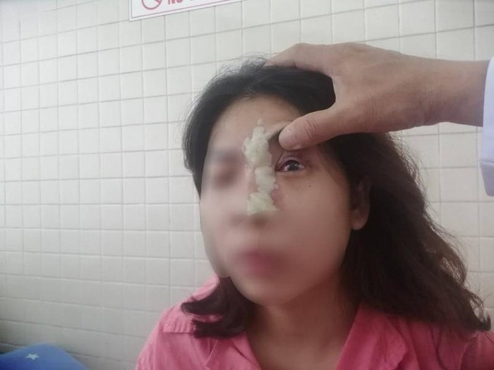 Cô gái bị mù mắt trái vì tiêm filler (Ảnh: HL)