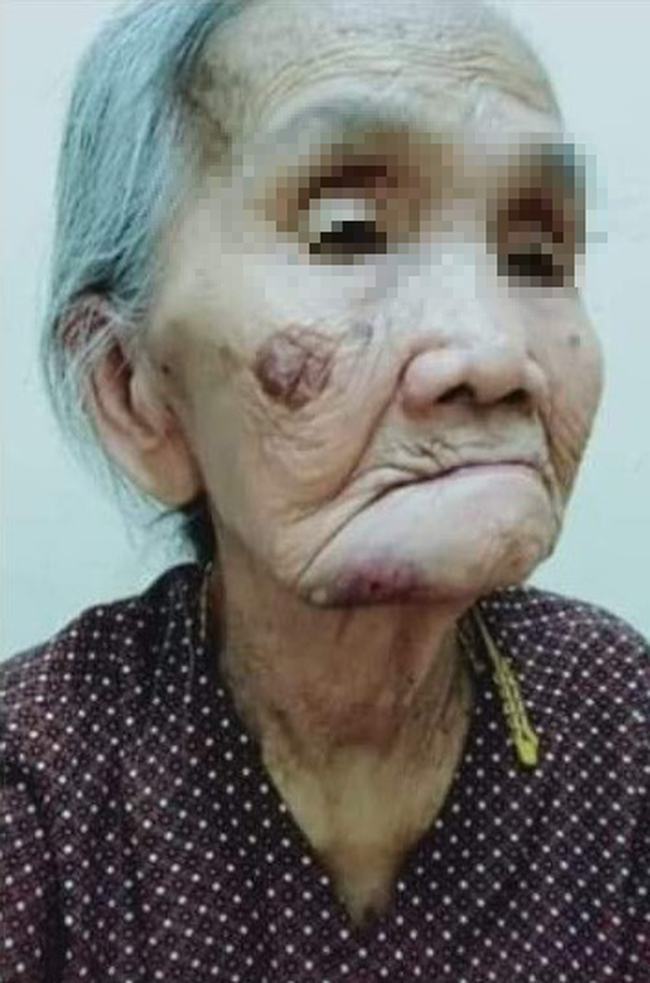 Bà cụ có nhiều vết thương trên mặt.