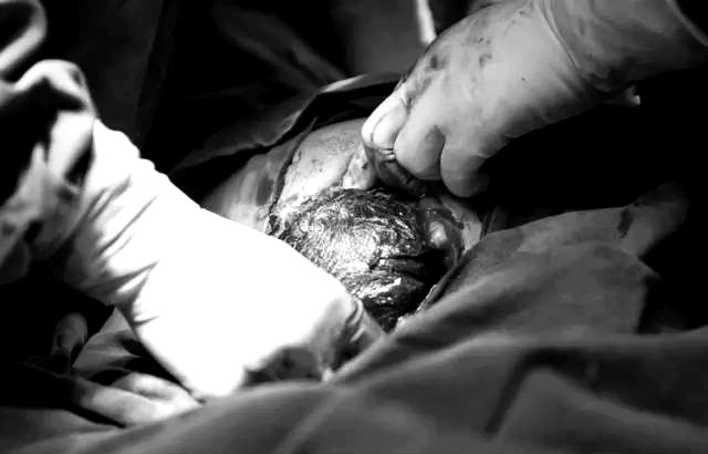 Khi cắt đến lớp màng cuối cùng đầu thai nhi sẽ lộ ra.