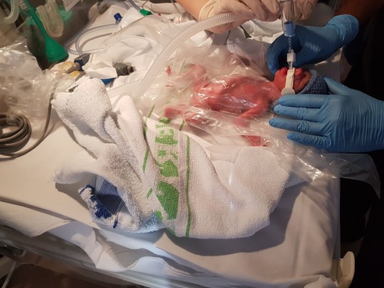 Hai bé chào đời với cân nặng chưa tới 1kg. Các bác sĩ đặt bé vào trong một chiếc túi nilon y tế để giữ ấm.