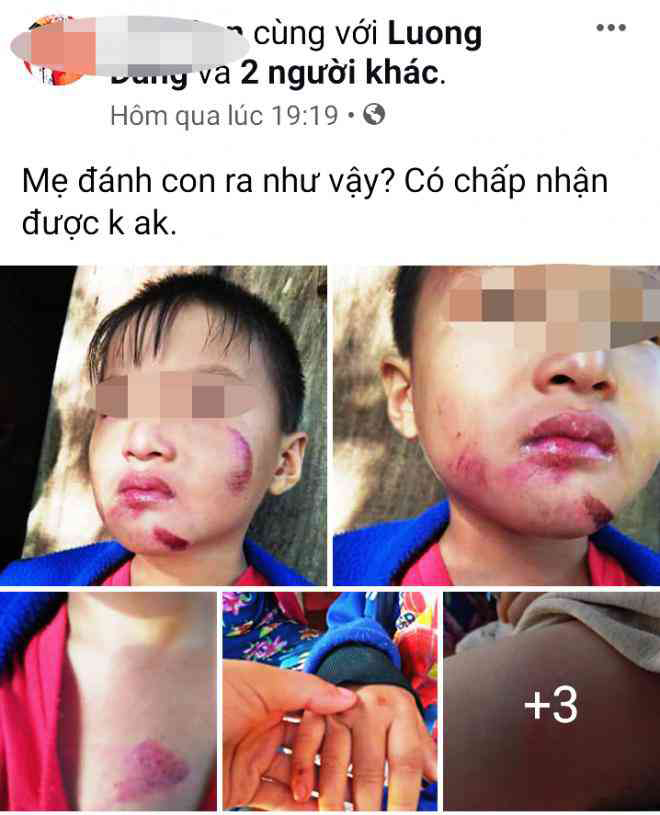 Hình ảnh bé trai 6 tuổi bị đánh bầm dập khắp người được chia sẻ trên mạng xã hội.