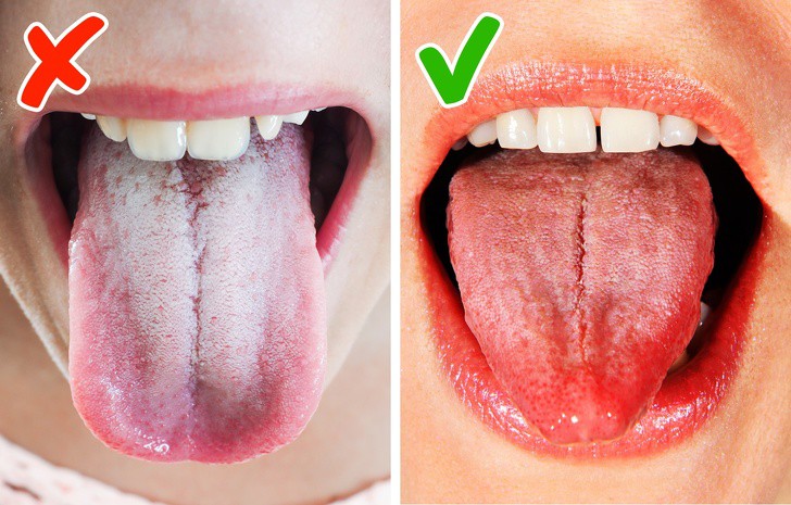 Lớp phủ mỏng màu trắng trên lưỡi có thể là dấu hiệu cơ thể đang thiếu sắt hoặc vitamin B.    