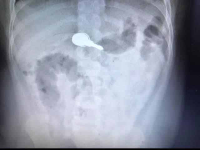 Phim chụp X-quang cho thấy chùm chìa khóa nằm trong dạ dày của bé trai 5 tuổi.