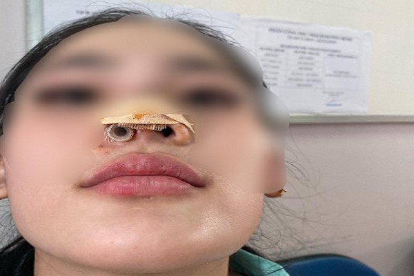 Mũi của cô gái đã bị biến dạng sau khi đi nâng tại spa.