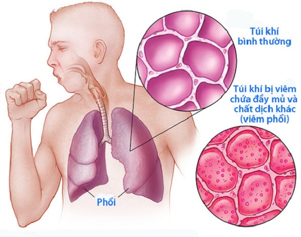 dau hieu benh phoi-phunutoday8