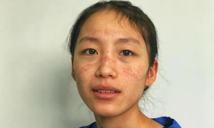 Gương mặt của nữ y tá chằng chịt những vết hằn vì phải đeo khẩu trang liên tục. Ảnh: Chinanews.