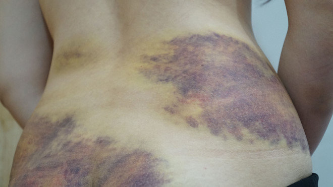 Người phụ nữ bị chồng bạo hành bầm tím cơ thể. Ảnh: báo Thanh Niên
