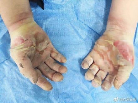 Đôi bàn tay bị bỏng nặng và được bác sĩ cấy ghép da.