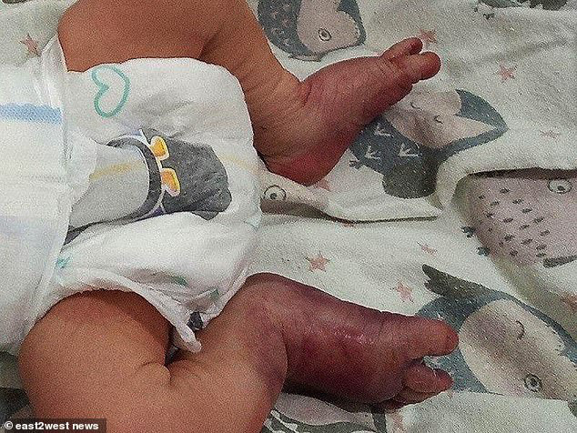 Bé trai bị gãy chân vì sinh tại nhà