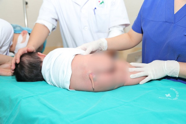 Bệnh nhi 5 tháng tuổi được phẫu thuật cắt bỏ chiếc đuôi bẩm sinh. (Ảnh: PV/Vietnam+)