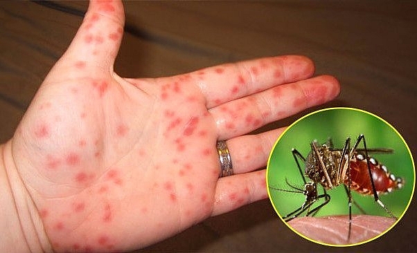 Sốt xuất huyết là bệnh truyền nhiễm cấp tính, do virus dengue gây ra.
