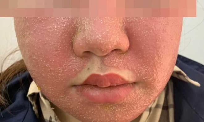 Da mặt của bệnh nhân bị sưng đỏ, mưng mủ sau 2 lần đắp mặt nạ.